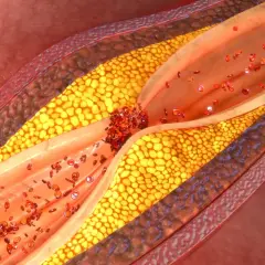 Cholesterol: Leki, działanie, skutki uboczne. Rozwiewamy mity!