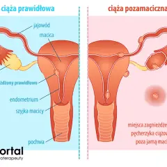 Objawy ciąży pozamacicznej: jak je rozpoznać i szybko reagować?