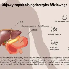 Objawy zapalenia pęcherzyka żółciowego: ból w prawym podżebrzu, wzdęcia, wymioty, problemy z trawieniem.