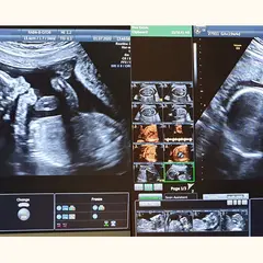 Badania prenatalne w 12 tyg. ciąży: USG genetyczne i PAPP-A bez obaw