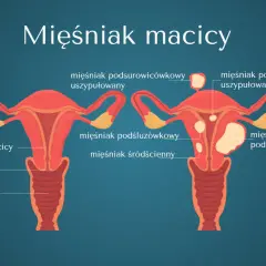 Rosnący mięśniak po menopauzie: Kiedy to sygnał alarmowy?