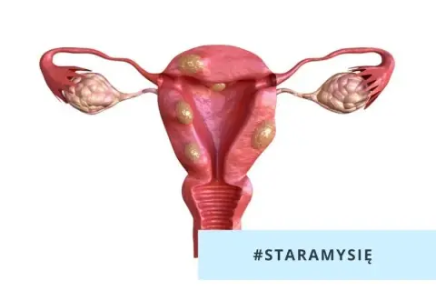 Mięśniaki macicy po menopauzie: Czy zanikają? Kiedy rosną?