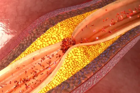 Cholesterol: Leki, działanie, skutki uboczne. Rozwiewamy mity!