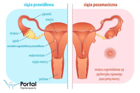 Objawy ciąży pozamacicznej: jak je rozpoznać i szybko reagować?