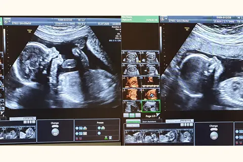 Badania prenatalne w 12 tyg. ciąży: USG genetyczne i PAPP-A bez obaw