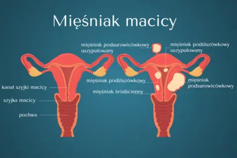 Rosnący mięśniak po menopauzie: Kiedy to sygnał alarmowy?
