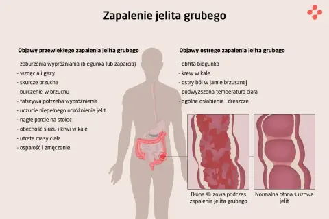 Zapalenie jelita grubego: objawy przewlekłe (biegunka, zaparcia, wzdęcia, bóle brzucha) i ostre (obfita biegunka, krew w kale, gorączka).