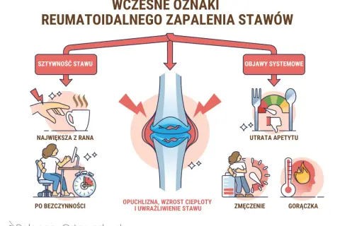 Wczesne objawy reumatoidalnego zapalenia stawów: sztywność stawów, utrata apetytu, zmęczenie, gorączka.
