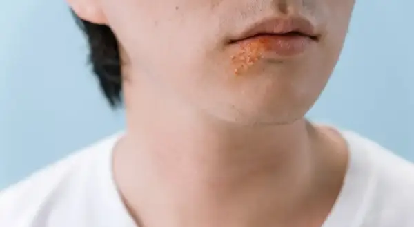 Zbliżenie na usta z widocznymi pęcherzykami opryszczki. Szukasz sposobu na opryszczkę w 1 dzień?