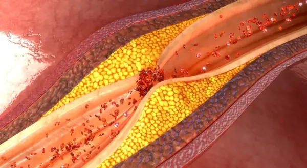 Cholesterol: Leki, działanie, skutki uboczne. Rozwiewamy mity!