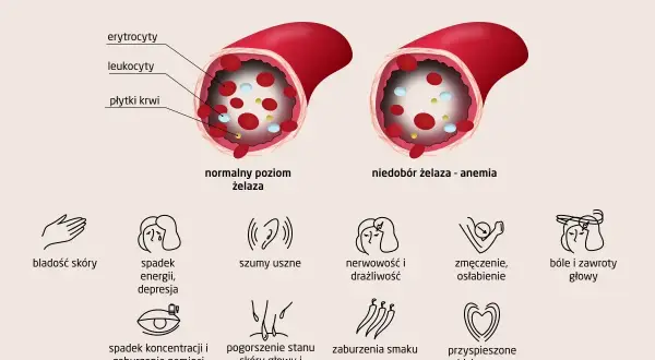 Silną anemia objawy: blada skóra, spadek energii, bóle głowy, zmęczenie, szumy uszne, zaburzenia pamięci, wypadanie włosów.