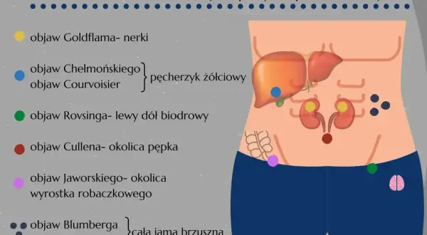 Ilustracja pokazuje lokalizację objawów wskazujących na ostry ból brzucha, np. objaw Cullena w okolicy pępka.
