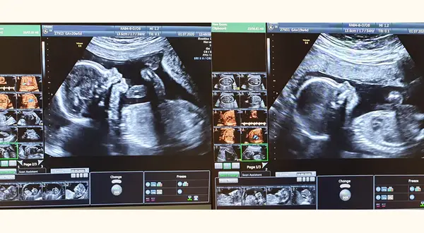 Badania prenatalne w 12 tyg. ciąży: USG genetyczne i PAPP-A bez obaw