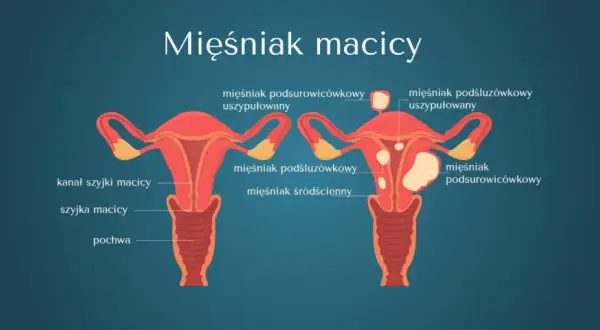 Rosnący mięśniak po menopauzie: Kiedy to sygnał alarmowy?