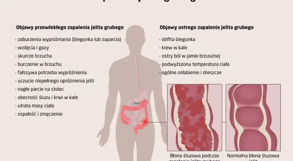 Zapalenie jelita grubego: objawy przewlekłe (biegunka, zaparcia, wzdęcia, bóle brzucha) i ostre (obfita biegunka, krew w kale, gorączka).