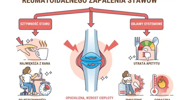 Wczesne objawy reumatoidalnego zapalenia stawów: sztywność stawów, utrata apetytu, zmęczenie, gorączka.
