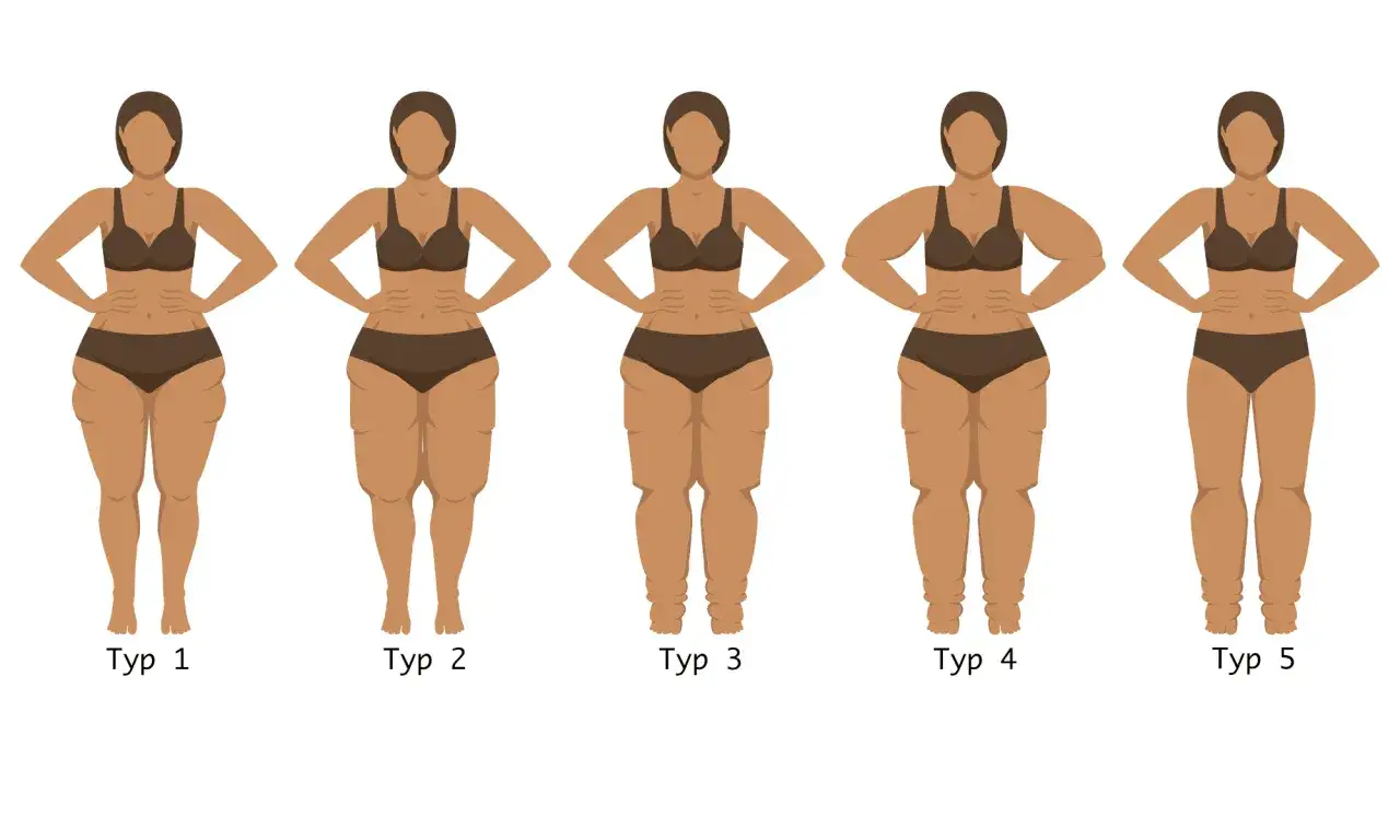 Lipedema, czyli obrzęk tłuszczowy - jak ją rozpoznać i leczyć