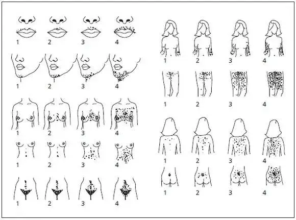 kobieta z problemem hirsutyzmu, diagnostyka hormonalna