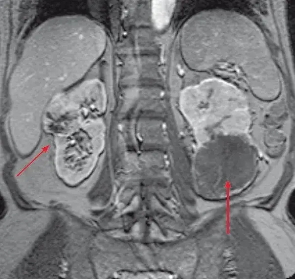 Obrazowanie nerek TK MRI urografia
