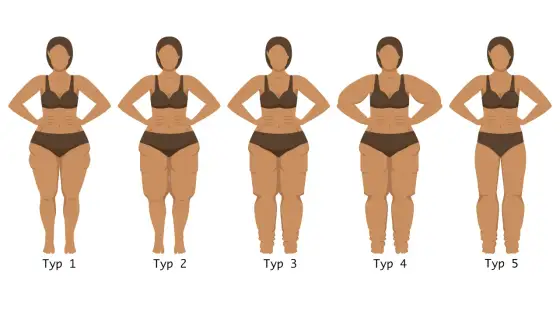 Lipedema, czyli obrzęk tłuszczowy - jak ją rozpoznać i leczyć