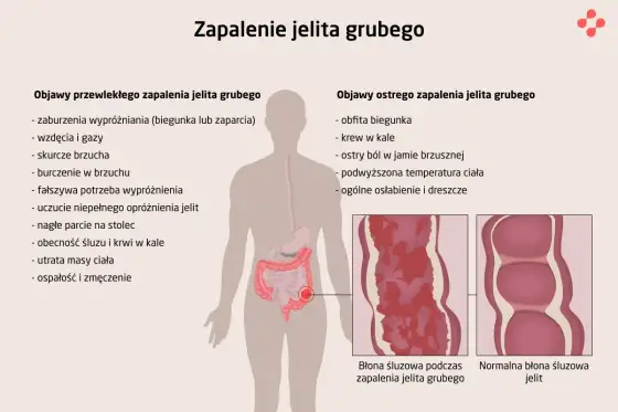 Stan zapalny jelit - jak rozpoznać objawy i kiedy reagować?